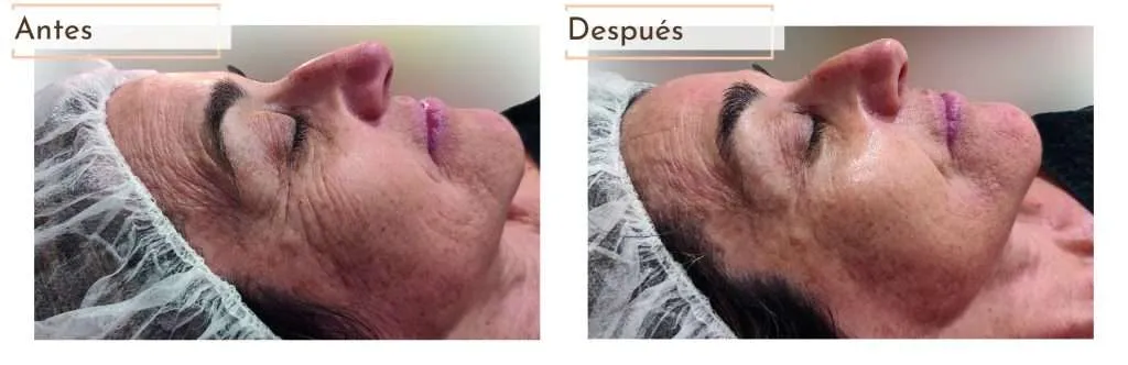 Fils fotodinàmics