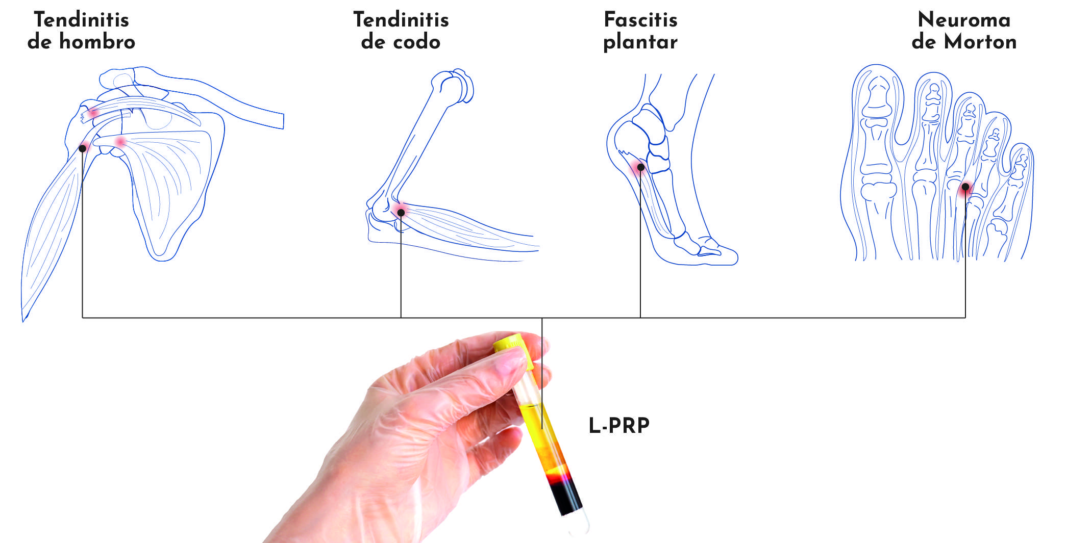 Aplicaciones de L-PRP