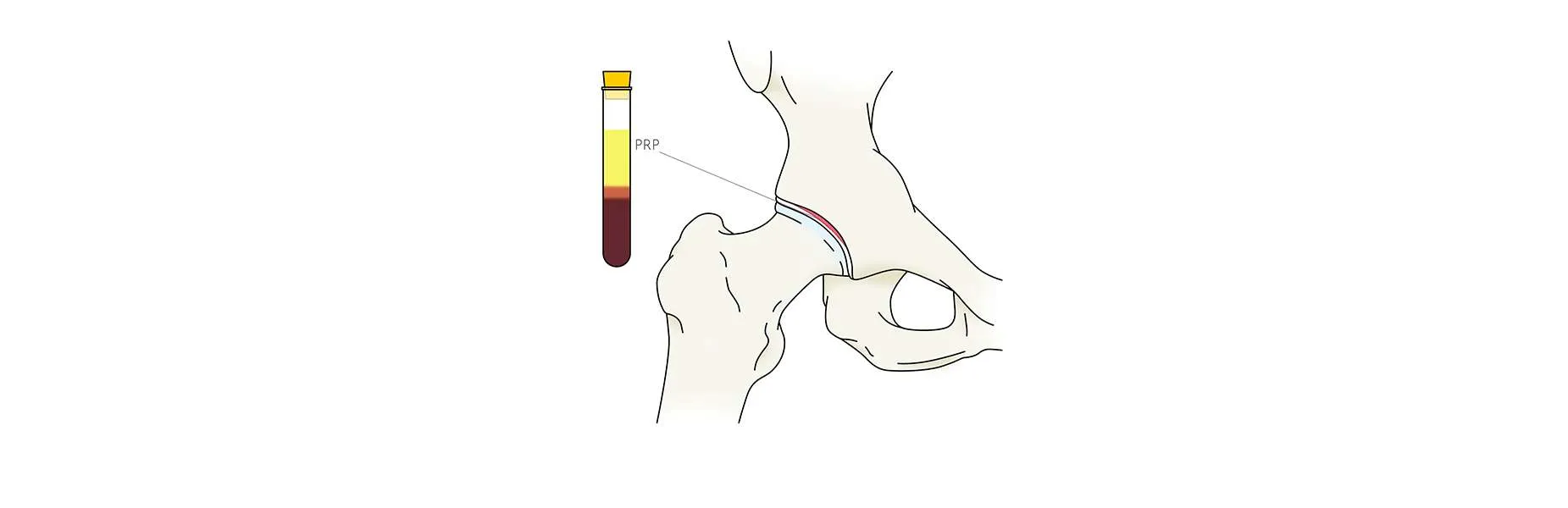 Pinçament de maluc