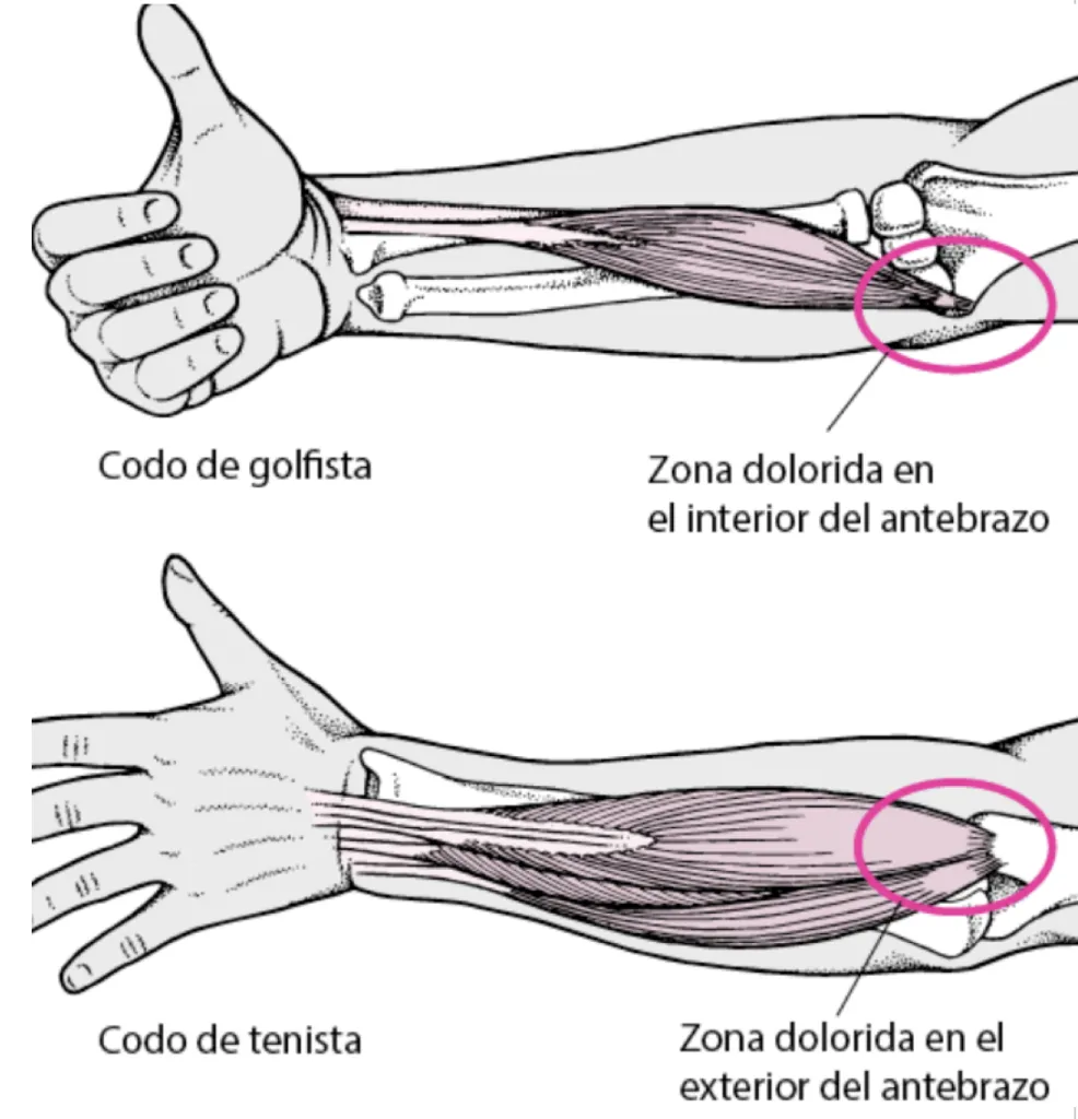Tendinitis de colze: consells i recomanacions