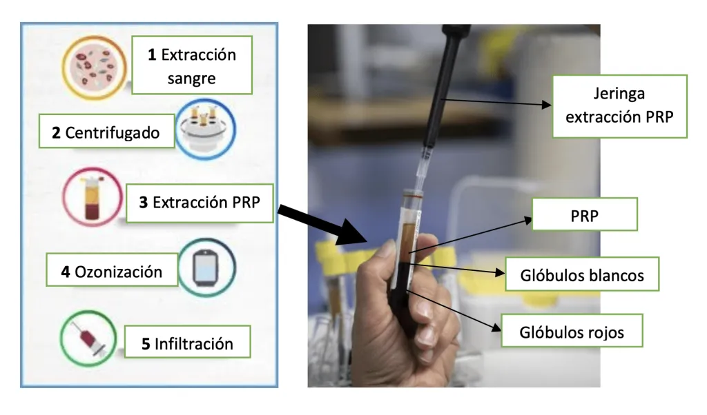 Viure sense dolor, els avantatges del tractament amb PRP