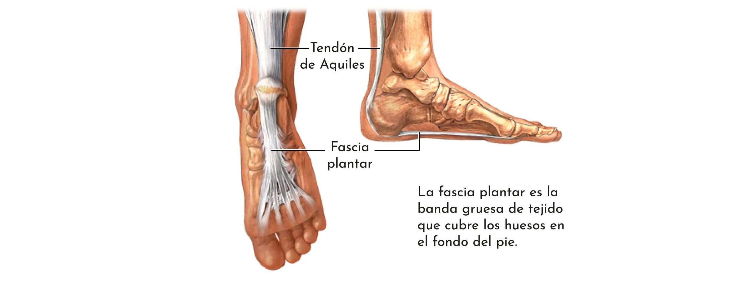 TENDINITIS DEL TENDÓ D’AQUIL·LES