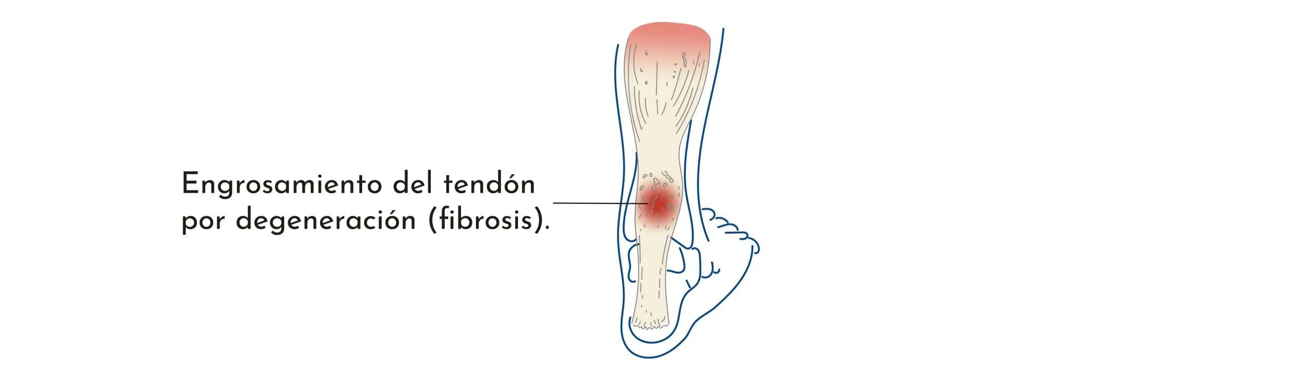 TENDINITIS DEL TENDÓ D’AQUIL·LES