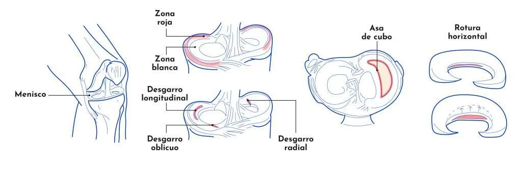 Pinçaments i lesions meniscals del genoll