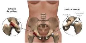 Artrosis de cadera grup policlinic