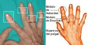 artrosis-manos-muneca-grup-policlinic
