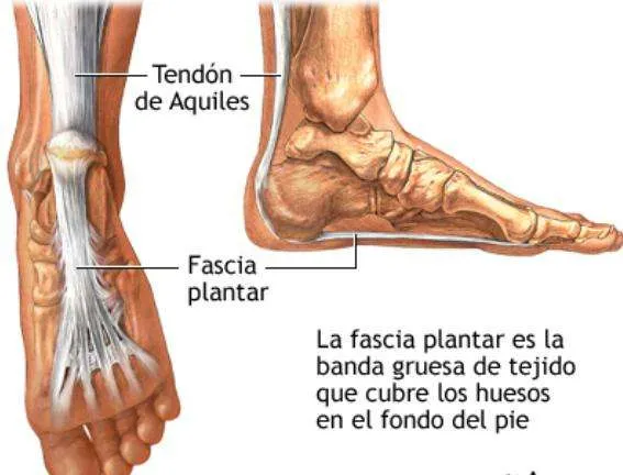 FASCITIS PLANTAR