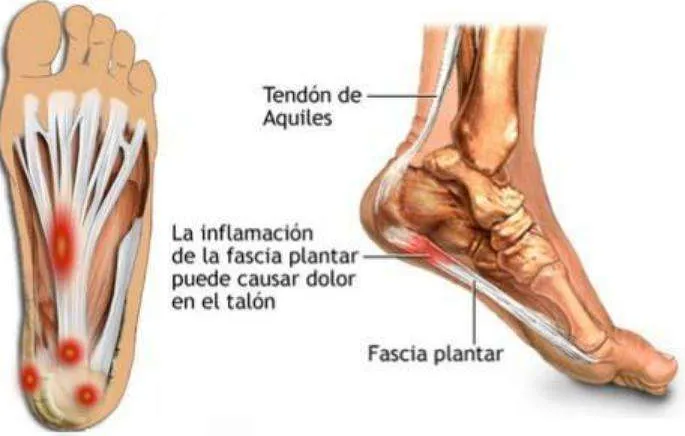 FASCITIS PLANTAR