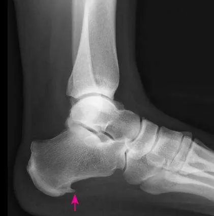 FASCITIS PLANTAR
