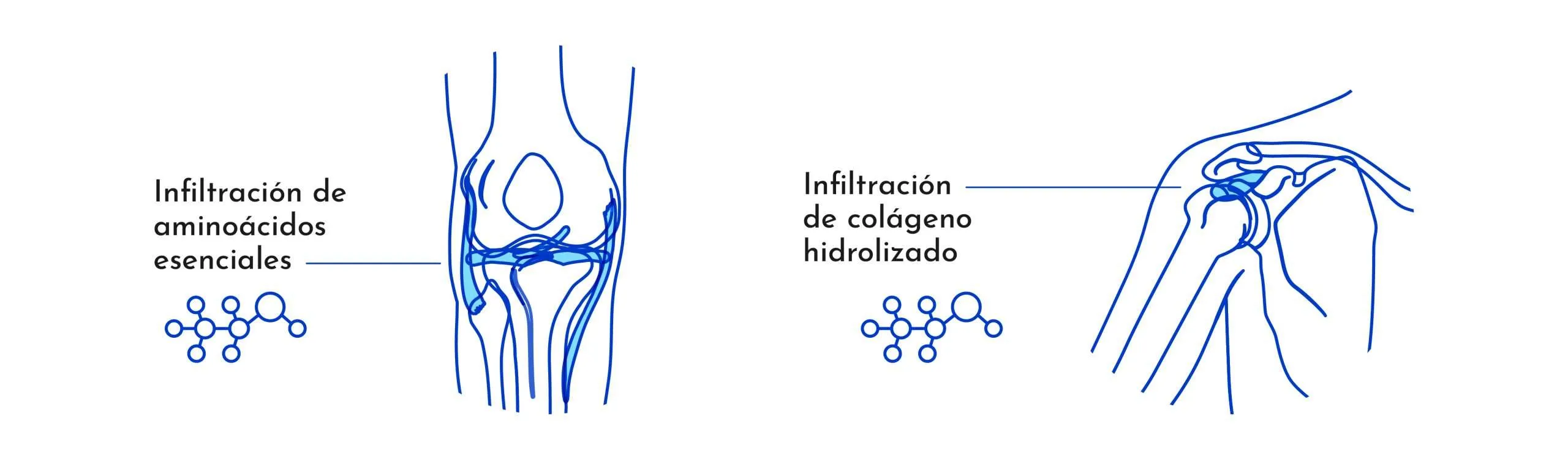 infiltración de colágeno.