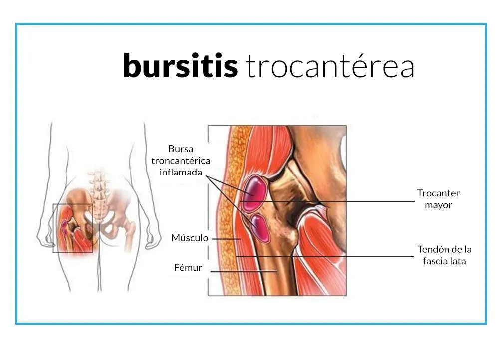 BURSITIS TROCANTÈRICA