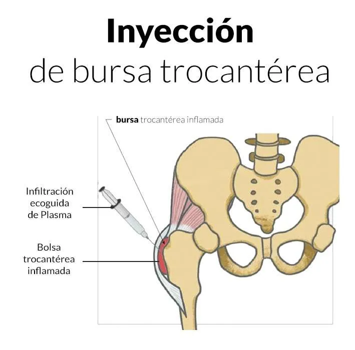 BURSITIS TROCANTÈRICA