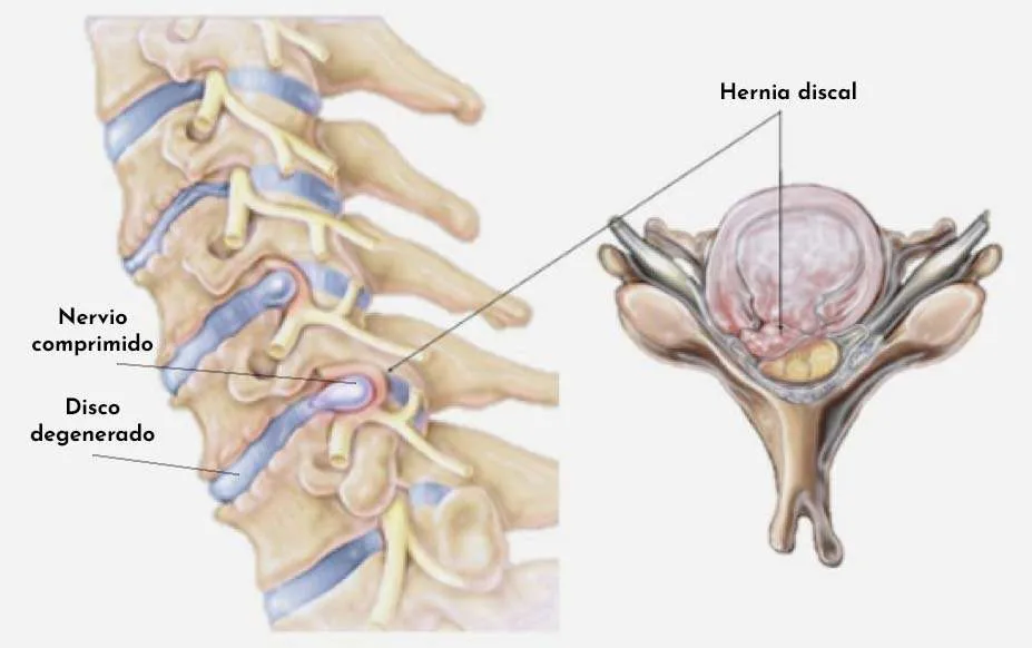 Cervicàlgia crònica: què és i com la tractem