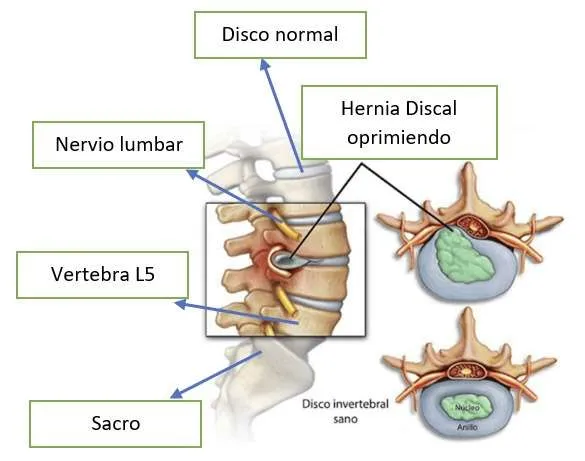 LUMBÀLGIA CRÒNICA