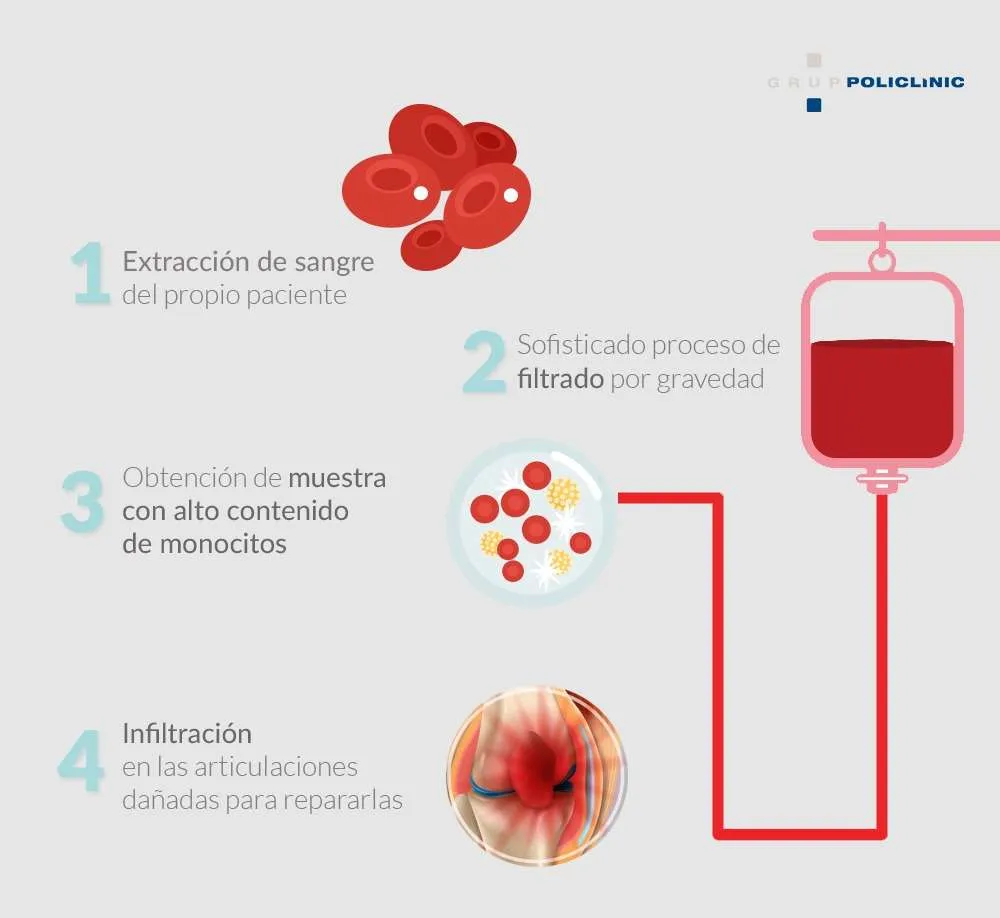 terapia con monocitos grup policlinic
