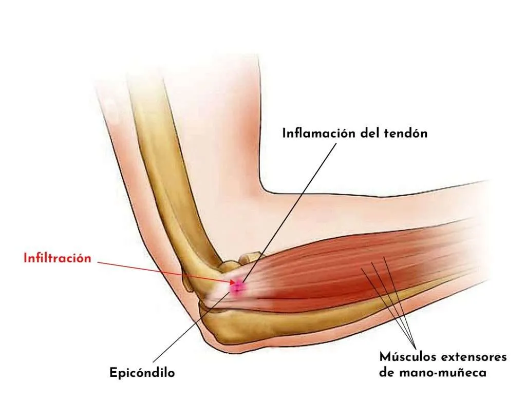 Tendinitis de colze: consells i recomanacions