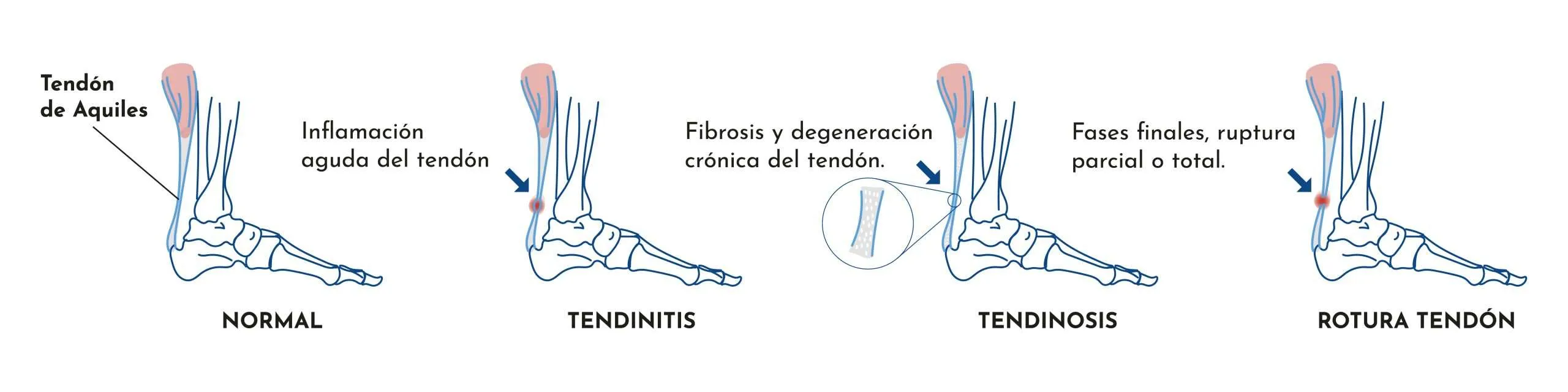 TENDINITIS DEL TENDÓ D’AQUIL·LES