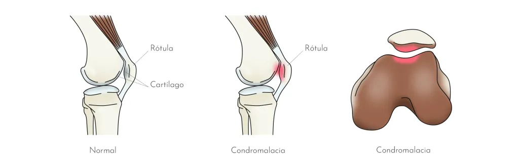 CONDROPATIA ROTULIANA