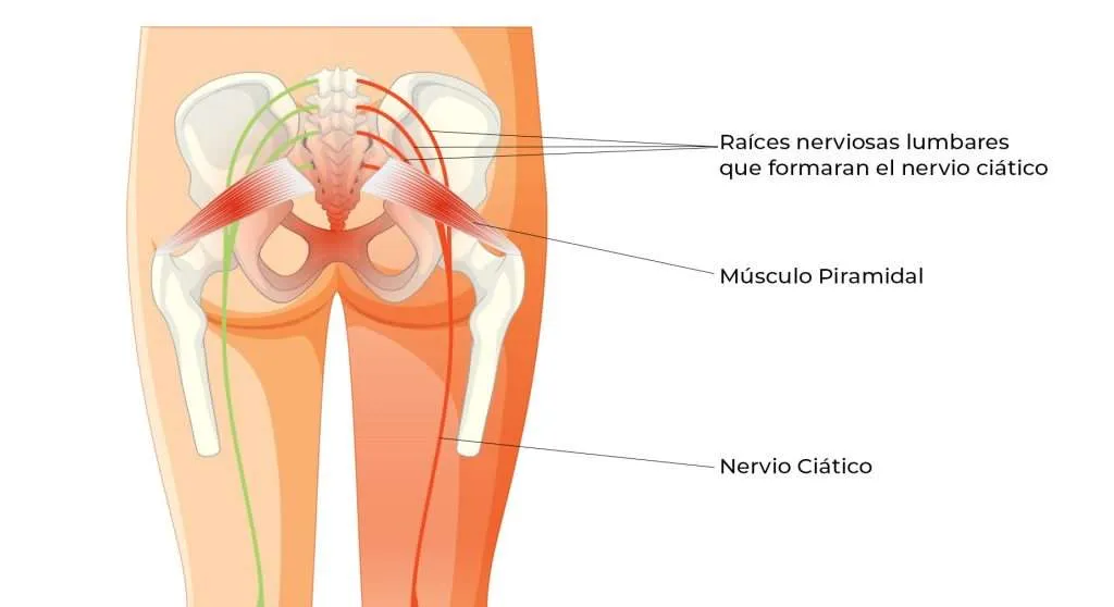 SÍNDROME PIRAMIDAL (Falsa ciàtica)