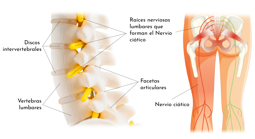 LUMBÀLGIA PER SÍNDROME FACETARI LUMBAR