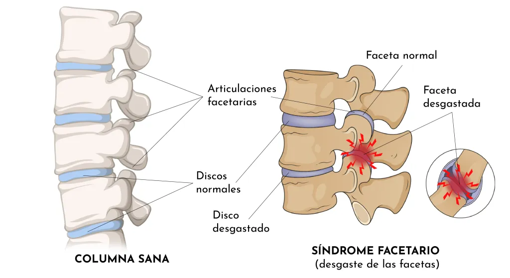 LUMBÀLGIA PER SÍNDROME FACETARI LUMBAR