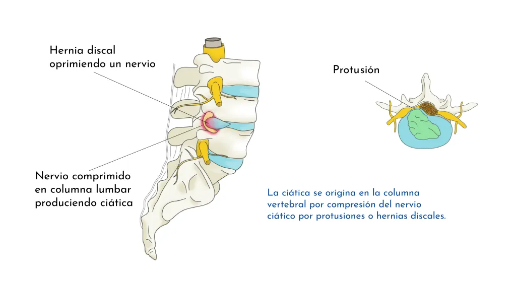 LUMBÀLGIA PER SÍNDROME FACETARI LUMBAR