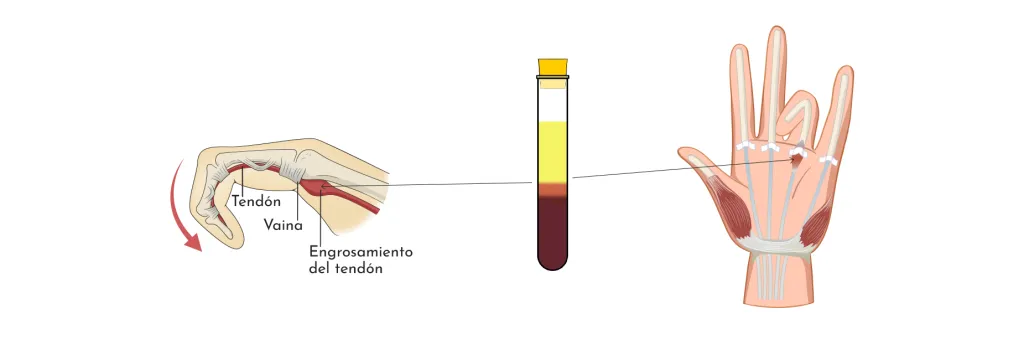 infiltracion-L-prp-vaina-y-tendon-dolor-grup-policlinic