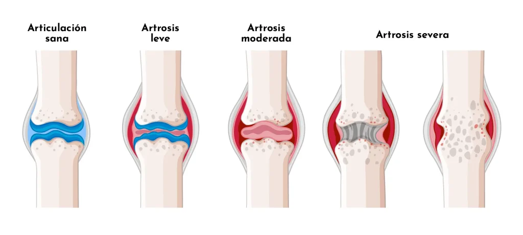 Artrosi i dolor crònic: causes, símptomes i solucions