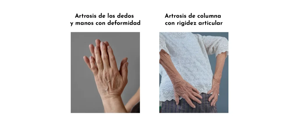 Artrosi i dolor crònic: causes, símptomes i solucions