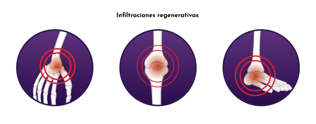 Medicina Regenerativa en artrosi: com millorar el dolor i frenar l’artrosi sense medicaments ni cirurgia