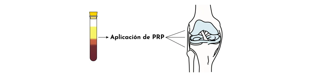 PRP-regenerativa-artrosis-grup-policlinic