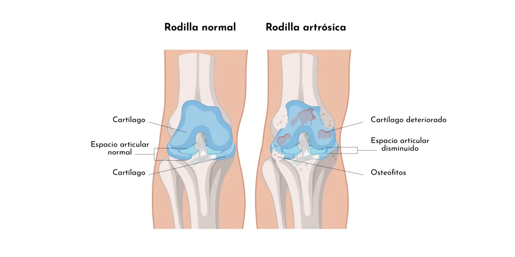 rodilla_sana-artrosica_Artrosis_dolor_cronico_Causas_sintomas_soluciones