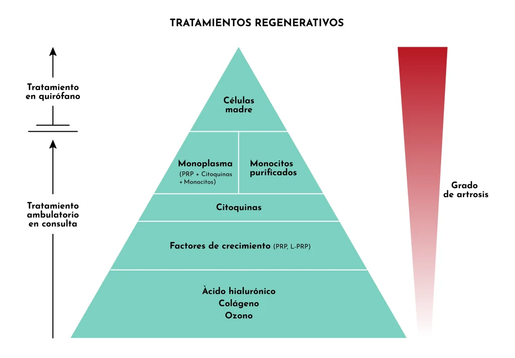 tratamientos-regenerativa_artrosis_grup_policlinic