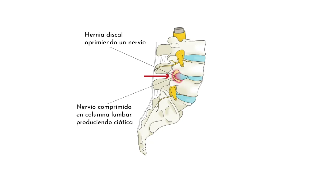 Protrusions, hèrnies discals i lumbociàtica