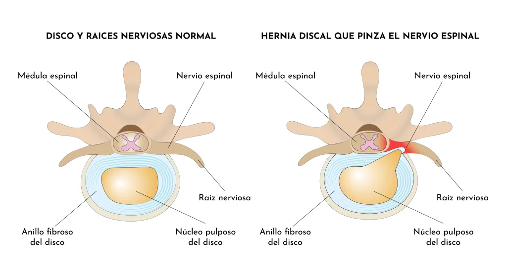 Protrusions, hèrnies discals i lumbociàtica