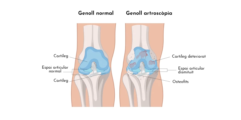 ARTROSI DE GENOLL