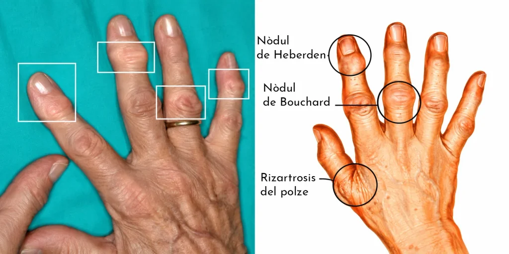 ARTROSI DE LES MANS I CANELL: CAUSES, SÍMPTOMES, CONSELLS I TRACTAMENTS