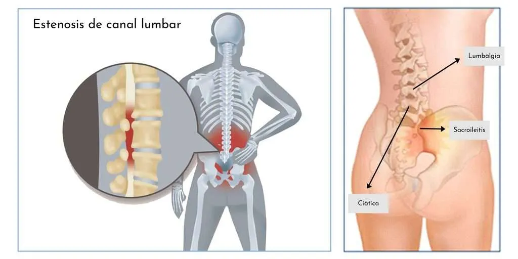 LUMBÀLGIA CRÒNICA