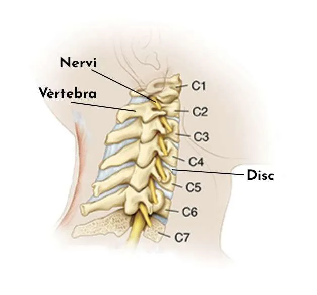 Cervicàlgia crònica: què és i com la tractem
