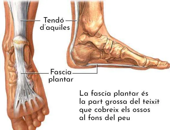 FASCITIS PLANTAR