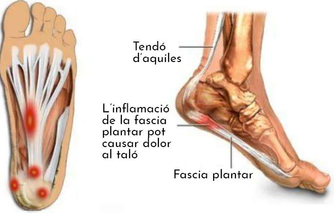 FASCITIS PLANTAR