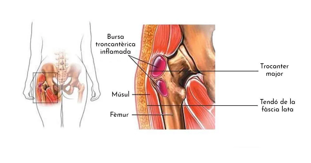 BURSITIS TROCANTÈRICA