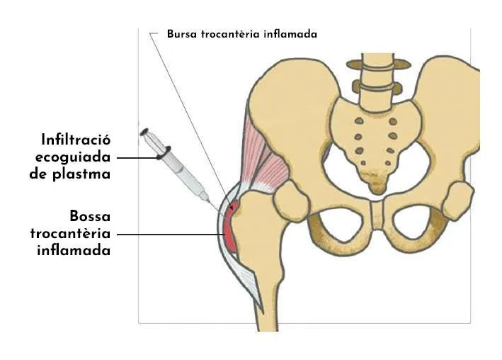 BURSITIS TROCANTÈRICA