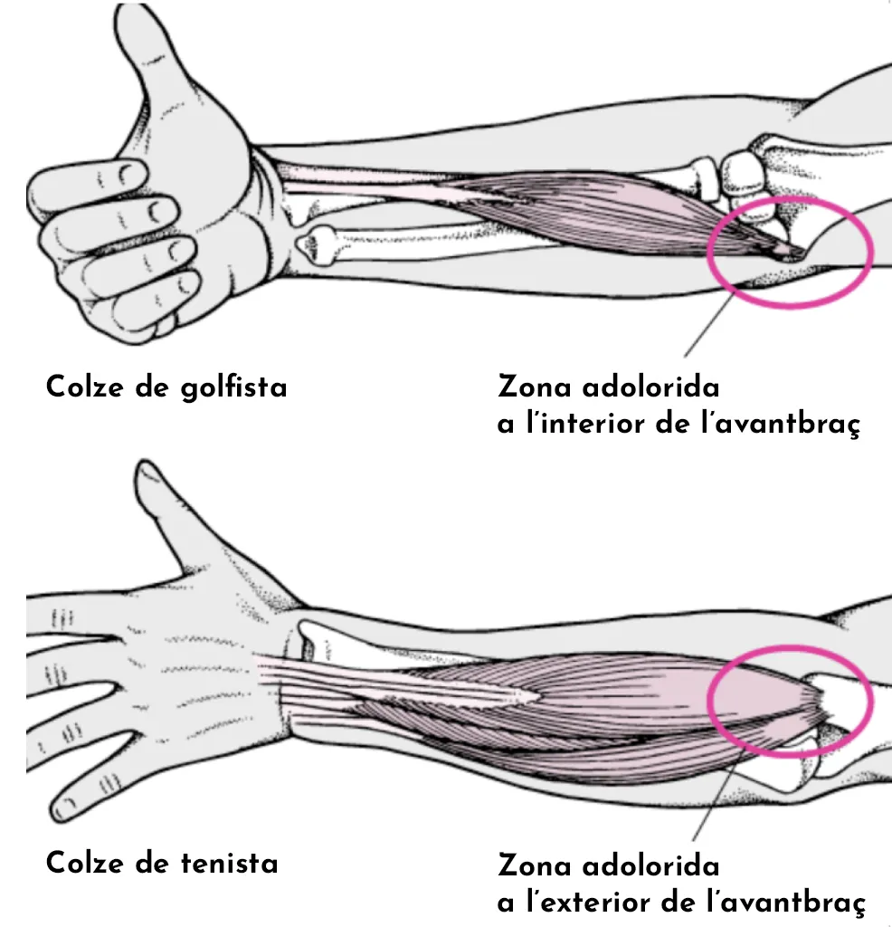 Tendinitis de colze: consells i recomanacions
