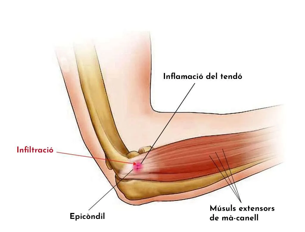 Tendinitis de colze: consells i recomanacions