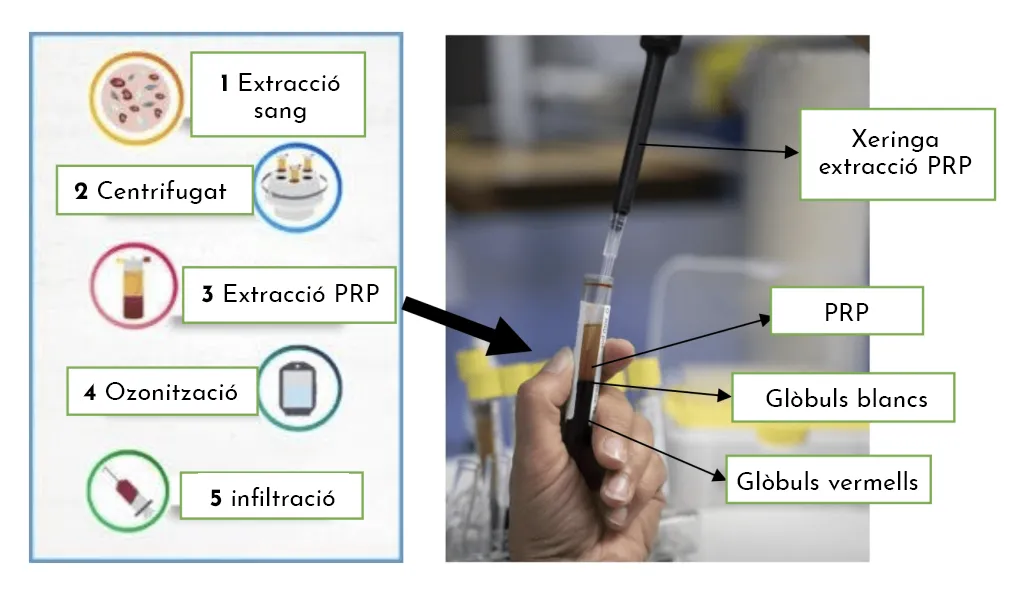Viure sense dolor, els avantatges del tractament amb PRP