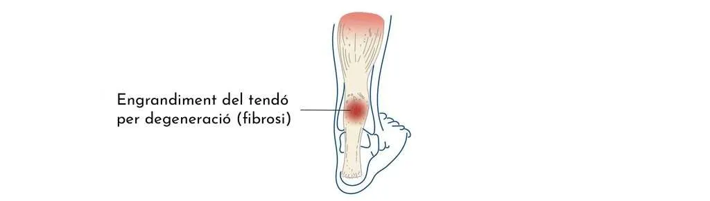 TENDINITIS DEL TENDÓ D’AQUIL·LES