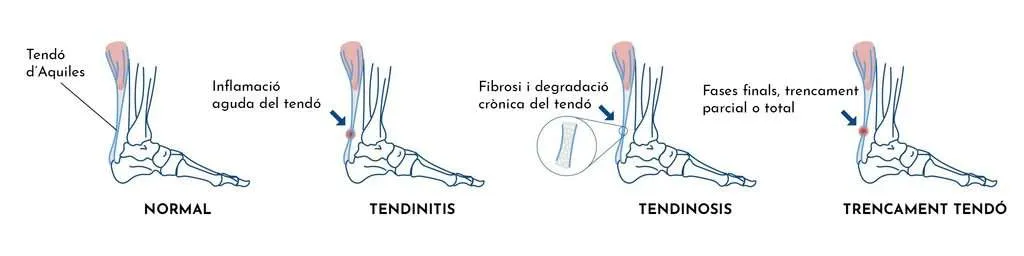 TENDINITIS DEL TENDÓ D’AQUIL·LES