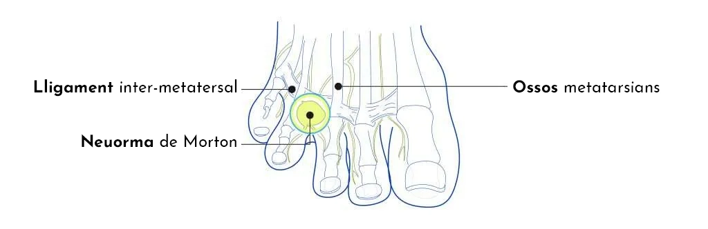 Neuroma de Morton
