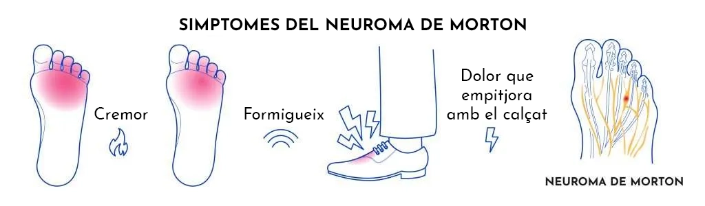 Neuroma de Morton
